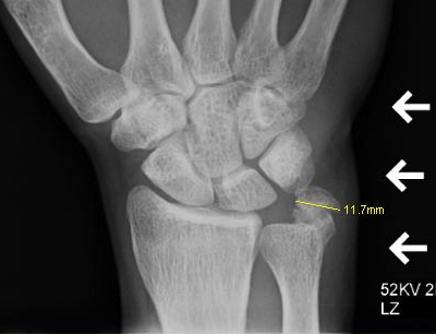 ECU Calcific Tendonitis